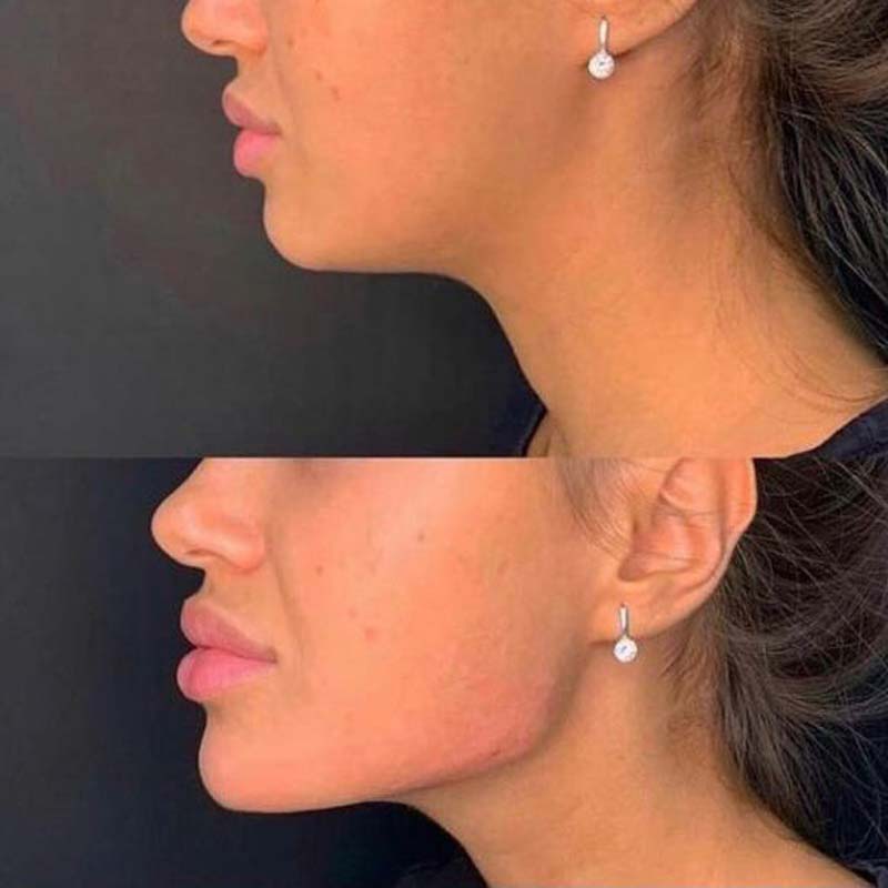 medecine-nutrition-et-danse--JAWLINE mandibular contour reshaping