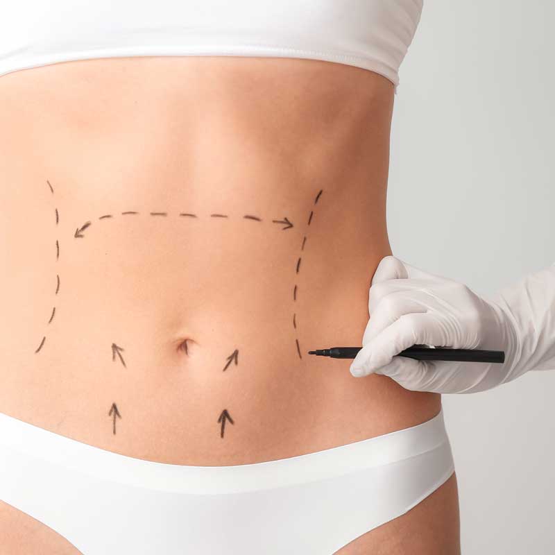 medecine-nutrition-et-danse- Abdominoplasty 