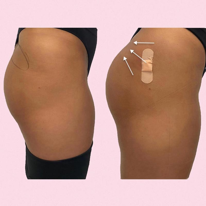 medecine-nutrition-et-danse-brasilian-butt-lift medecine-nutrition-et-danse-brasilian-butt-lift