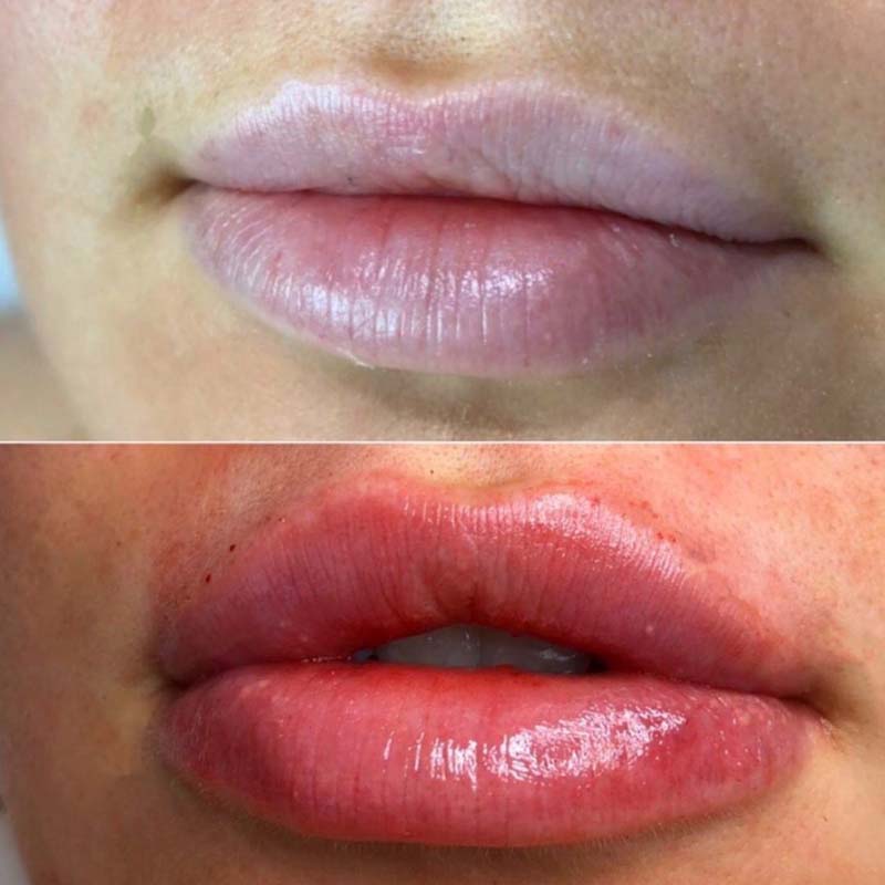 medecine-nutrition-et-danse-Lip filler