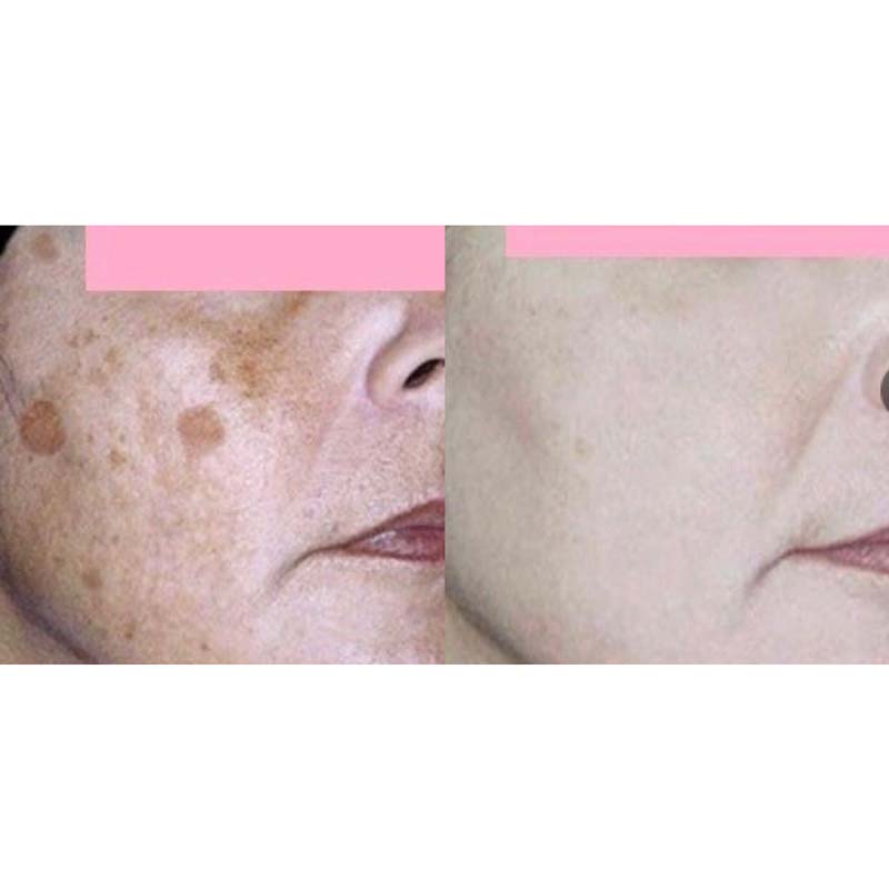 medecine-nutrition-et-danse-Resurfacing laser rejuvenation photo