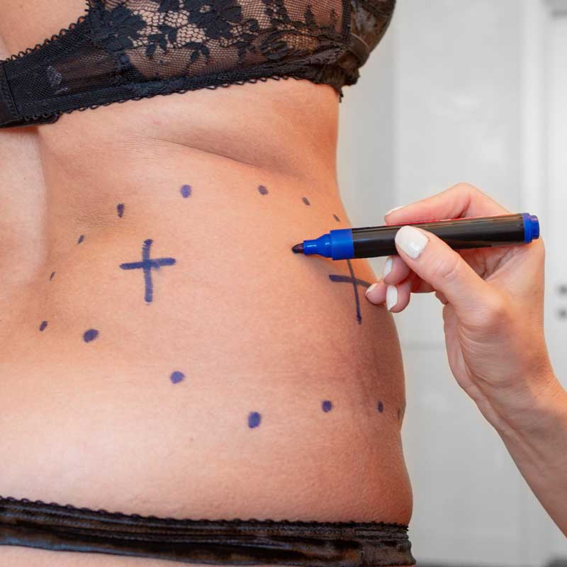 medecine-nutrition-et-danse-Liposuction medecine-nutrition-et-danse-Liposuction