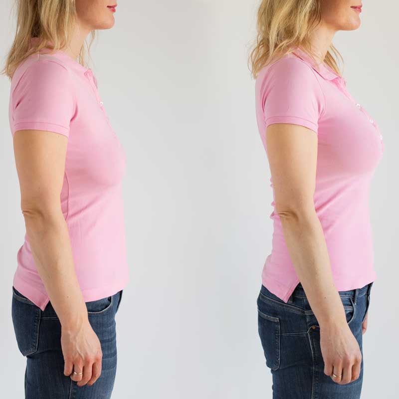 medecine-nutrition-et-danse-Mastopexy medecine-nutrition-et-danse-Mastopexy