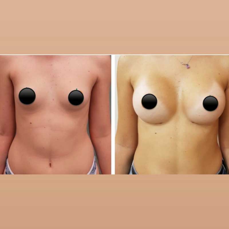 medecine-nutrition-et-danse-Mastoplasty breast