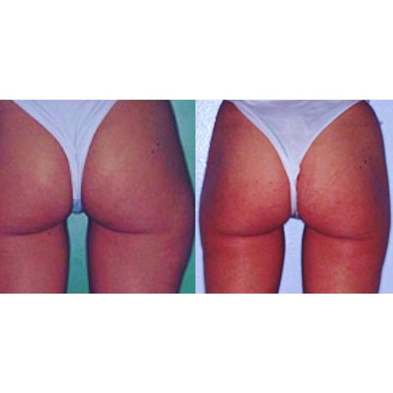 medecine-nutrition-et-danse-Mesotherapy and medical liposuction medecine-nutrition-et-danse-Mesotherapy and medical liposuction