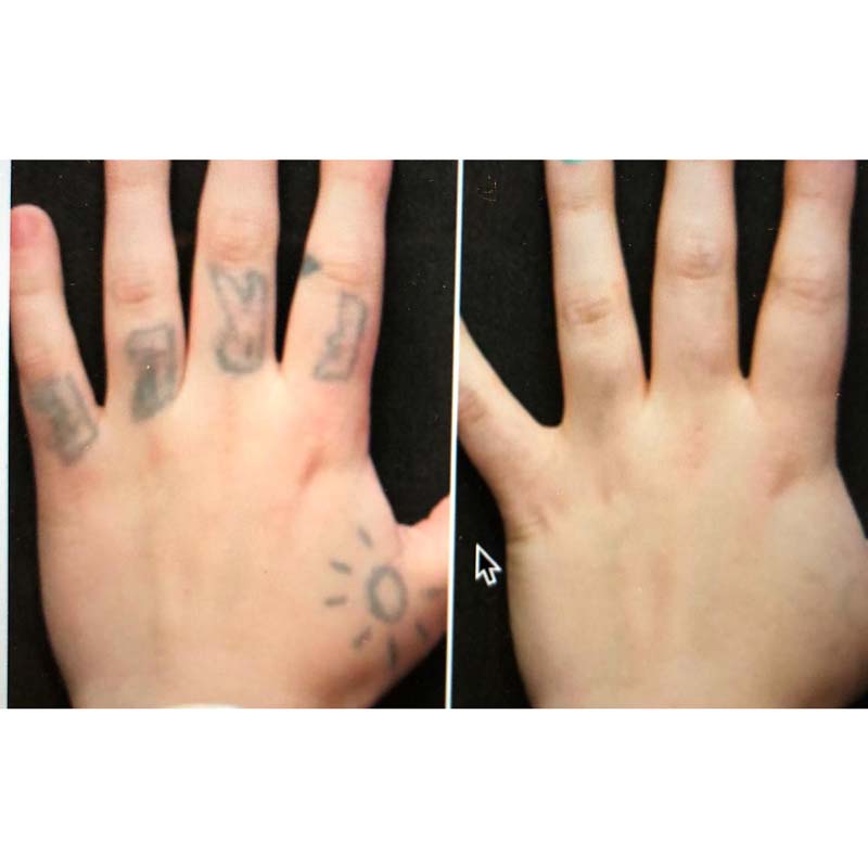 medecine-nutrition-et-danse-Tattoo removal medecine-nutrition-et-danse-Tattoo removal