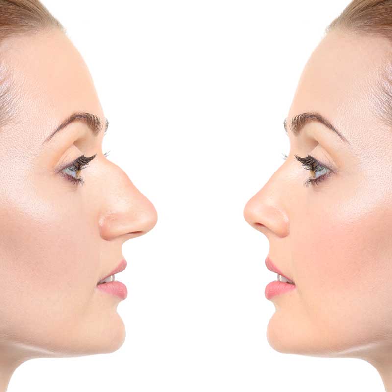 medecine-nutrition-et-danse-rhinoplastie