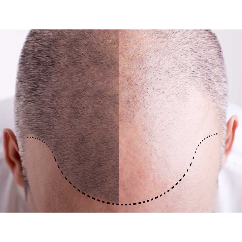 medecine-nutrition-et-danse-Hair transplant