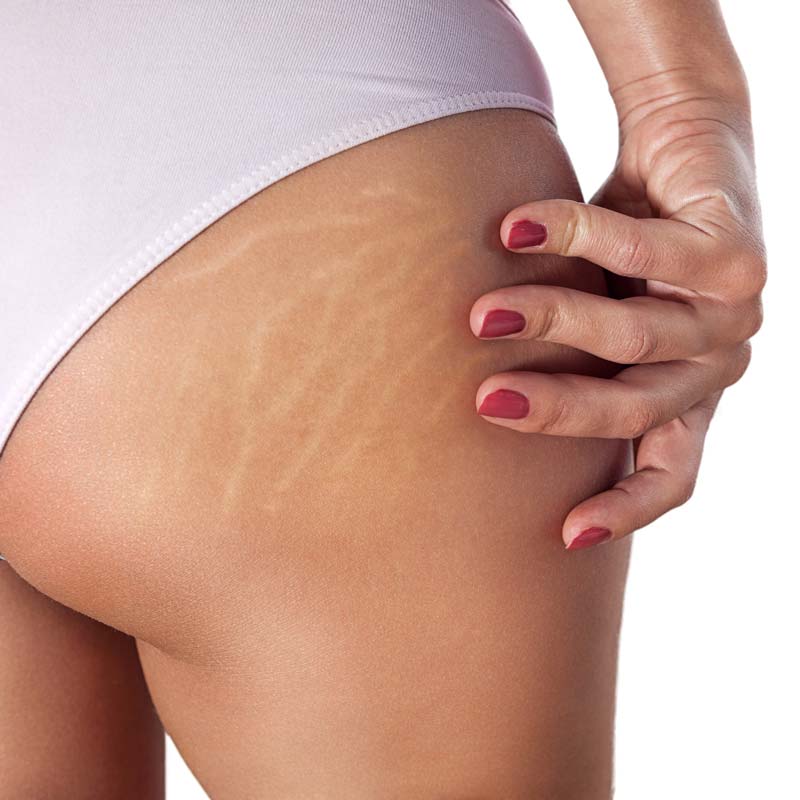 medecine-nutrition-et-danse-Stretch marks treatment