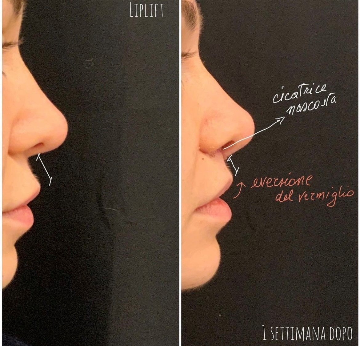 Lip lift Lip lift