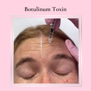 Botox full face tutorial