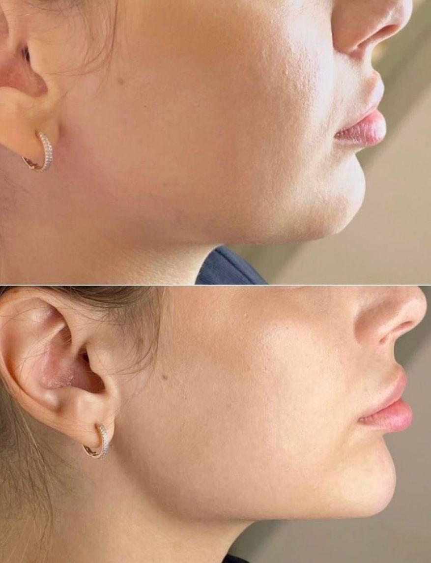 JAWLINE mandibular contour reshaping medecine-nutrition-et-danse--JAWLINE mandibular contour reshaping